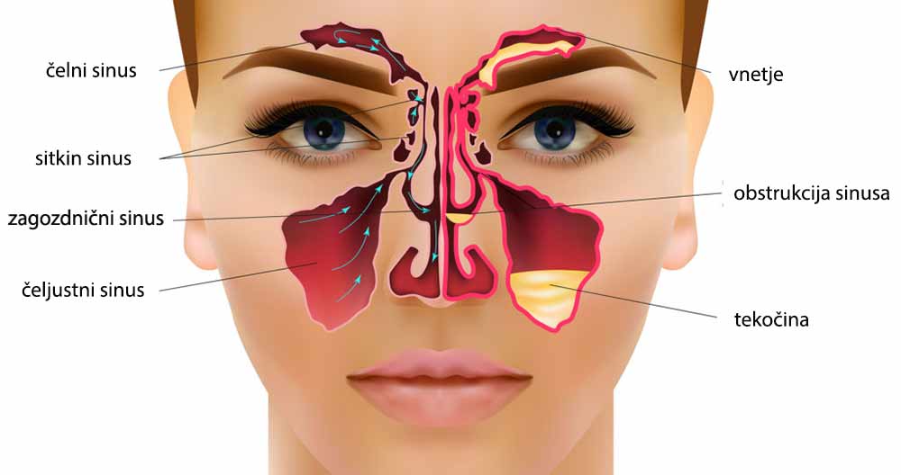 izgled-sinusov-lekarna